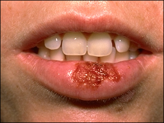 How Can I Treat Herpes Simplex : Cold Sores - Treatment Through Cold Sores