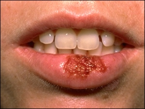 symptoms of herpes