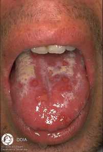 Symptoms of Herpes